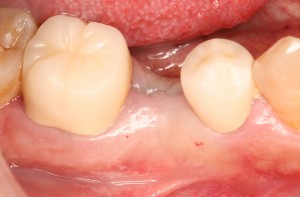 張２　埋入直前